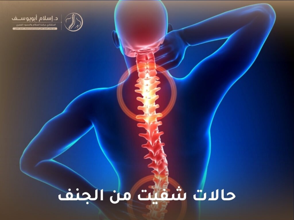 حالات شفيت من الجنف