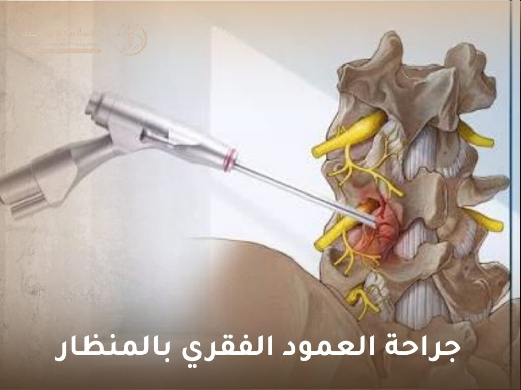 جراحة العمود الفقري بالمنظار