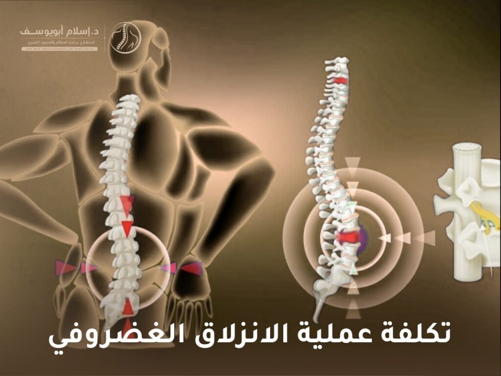 تكلفة عملية الانزلاق الغضروفي
