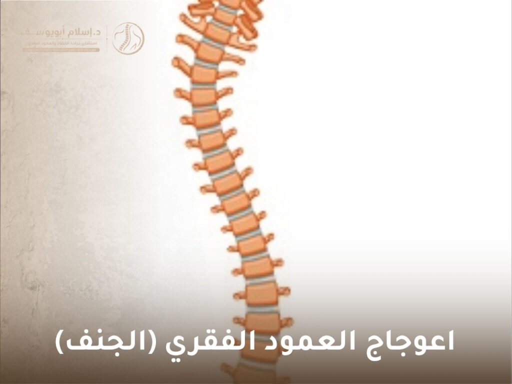 اعوجاج العمود الفقري