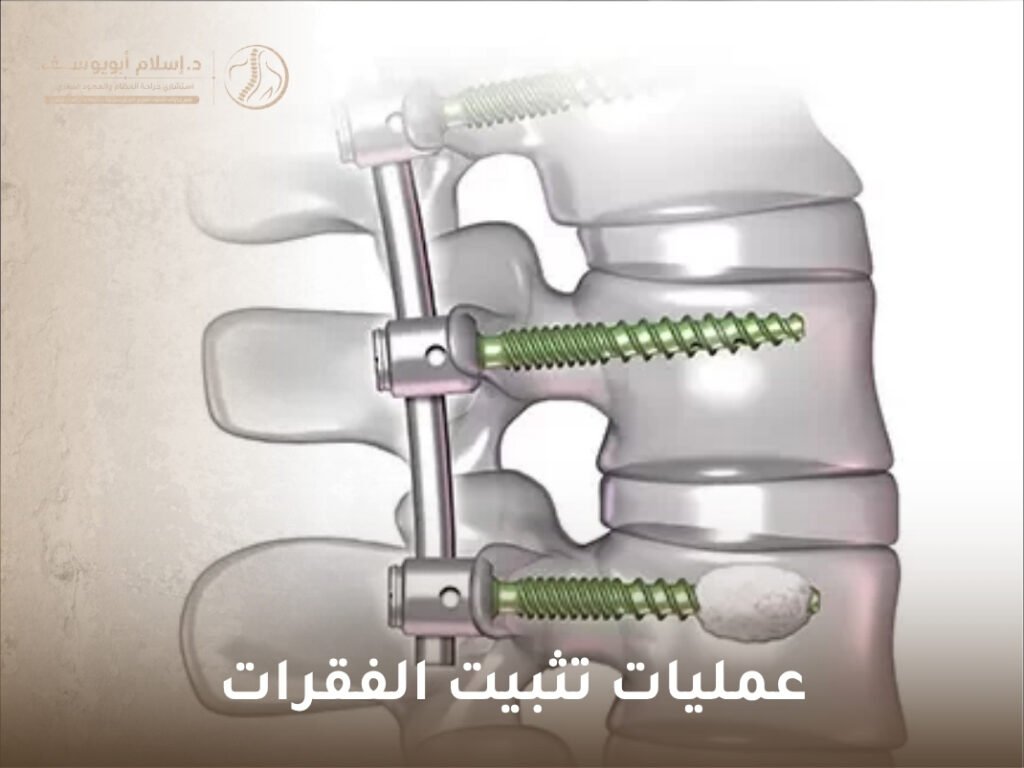 عمليات تثبيت الفقرات