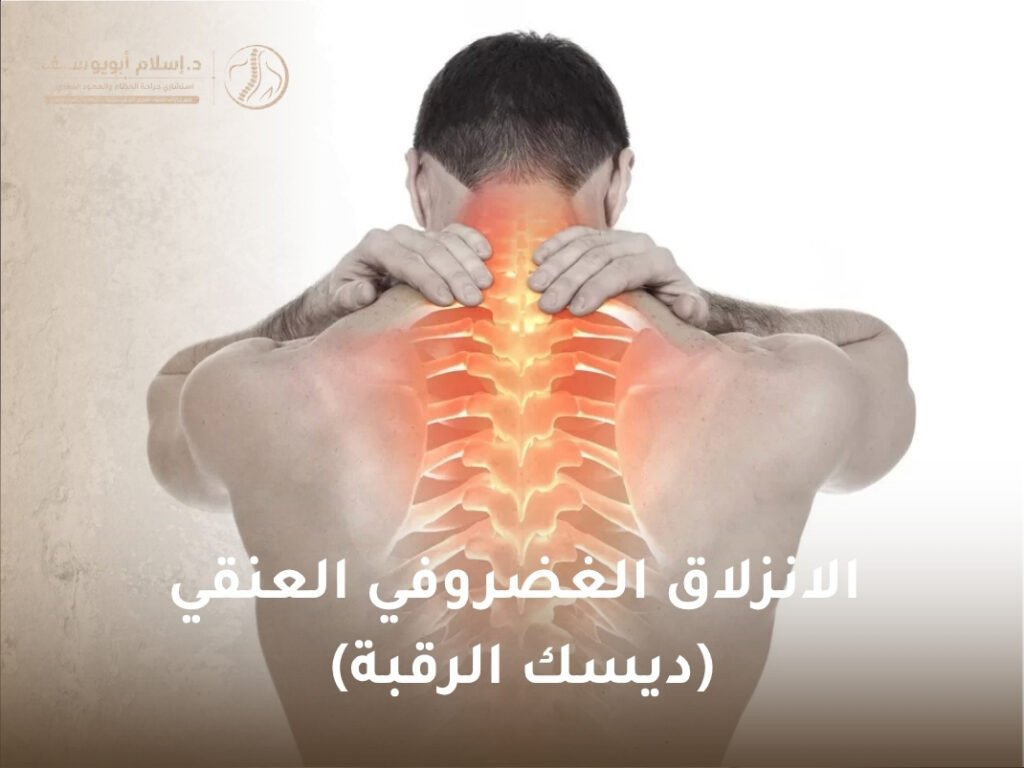 الانزلاق الغضروفي العنقي