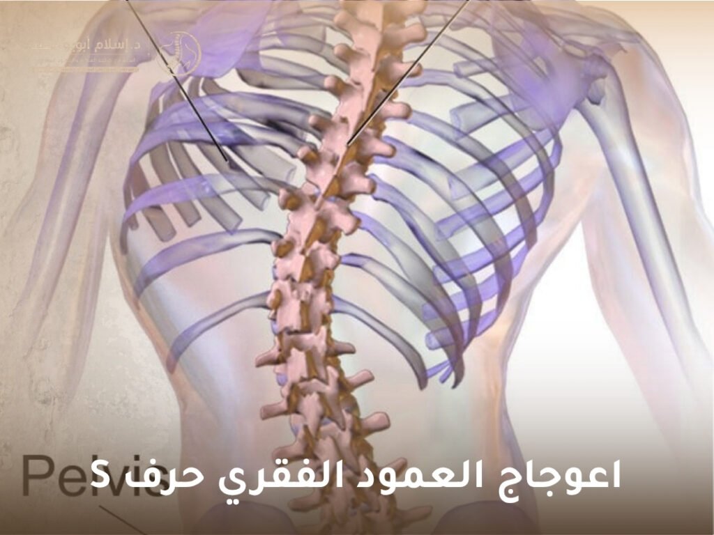 اعوجاج العمود الفقري حرف S