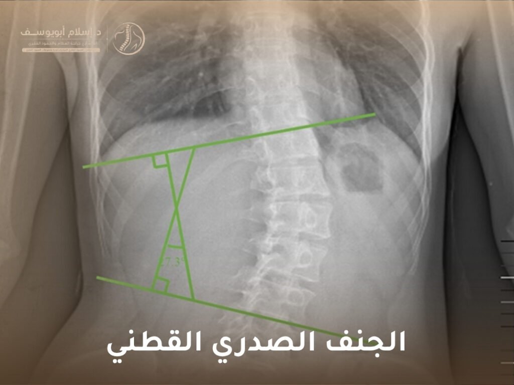 الجنف الصدري القطني