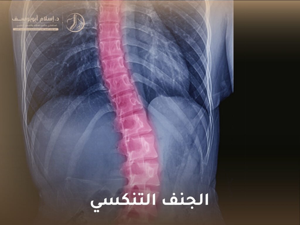 الجنف التنكسي