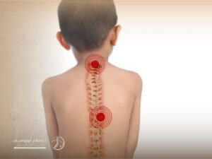 مشاكل العمود الفقري عند الأطفال