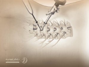 جراحة العمود الفقري بالمنظار
