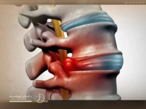 تكلفة عملية الانزلاق الغضروفي