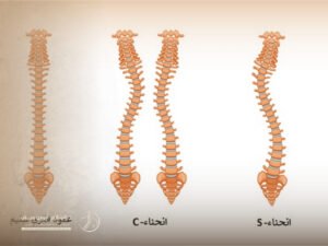 اعوجاج العمود الفقري