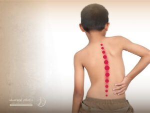 علاج اعوجاج العمود الفقري حسب العمر
