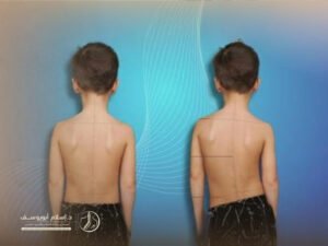 علاج اعوجاج العمود الفقري عند الأطفال