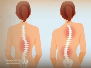 علاج اعوجاج العمود الفقري