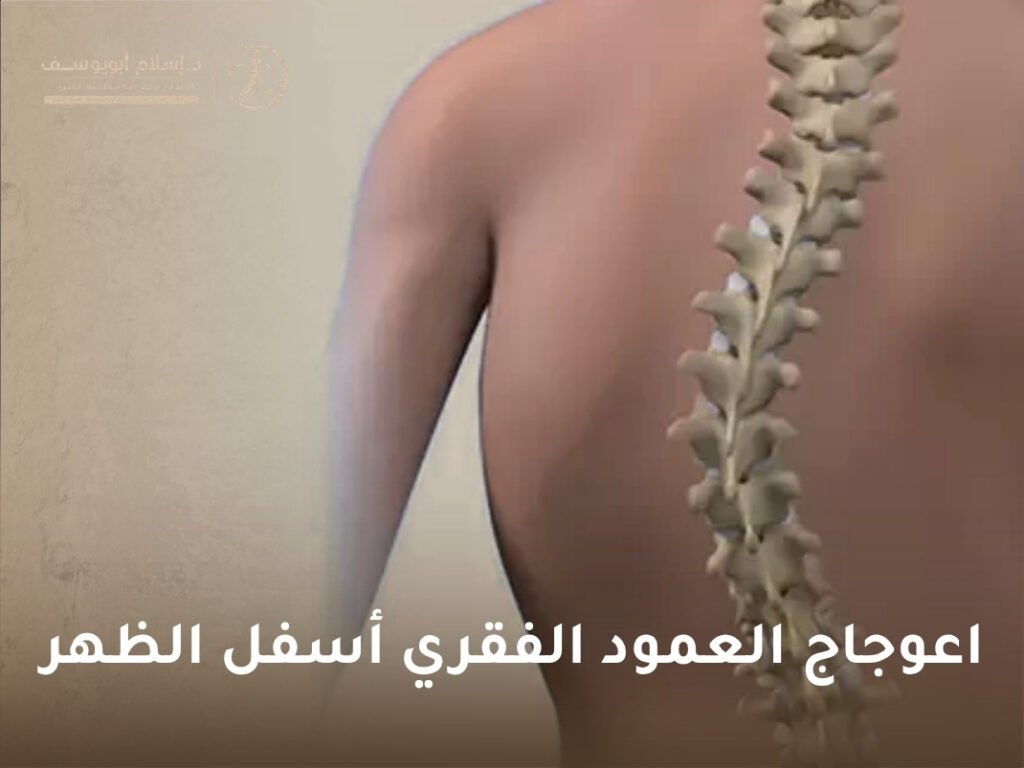 اعوجاج العمود الفقري القطني