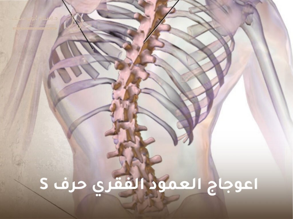 اعوجاج العمود الفقري حرف S