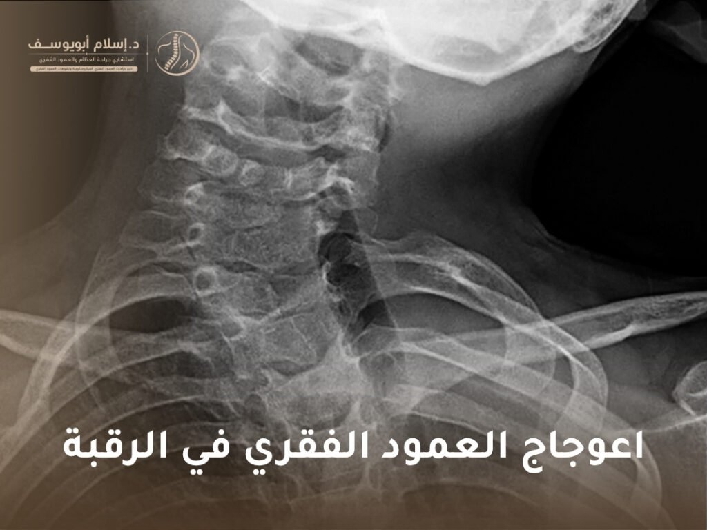 اعوجاج العمود الفقري في الرقبة