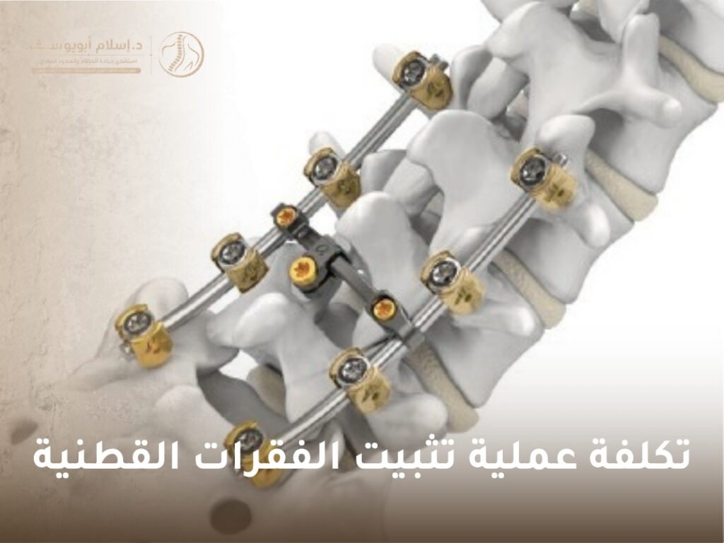 تكلفة عملية تثبيت الفقرات القطنية
