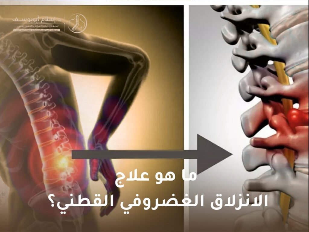 علاج الانزلاق الغضروفي القطني