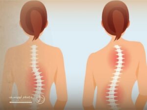اعوجاج العمود الفقري القطني