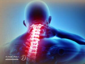 اعوجاج العمود الفقري في الرقبة