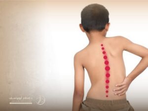 تشوهات العمود الفقري عند الأطفال