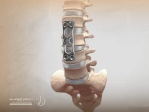 تكلفة عملية تثبيت الفقرات القطنية