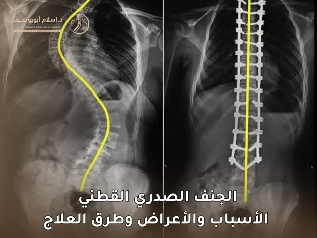 الجنف الصدري القطني