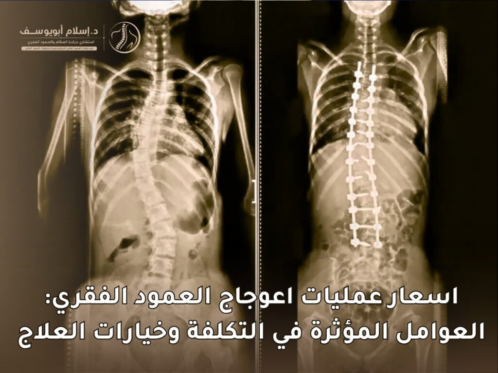اسعار عمليات اعوجاج العمود الفقري