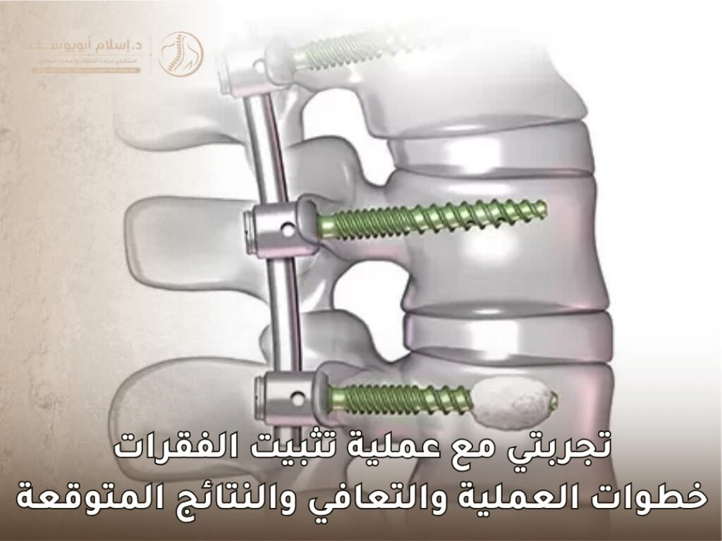 تجربتي مع عملية تثبيت الفقرات