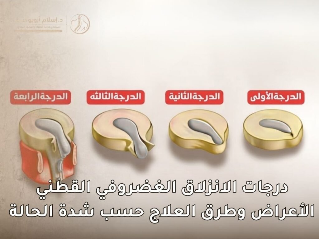 درجات الانزلاق الغضروفي القطني