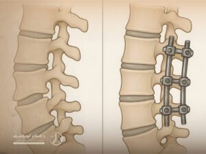 تجربتي مع عملية تثبيت الفقرات