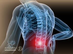 علاج اعوجاج العمود الفقري عند الشباب
