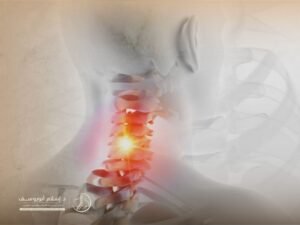 علاج الانزلاق الغضروفي في الرقبة